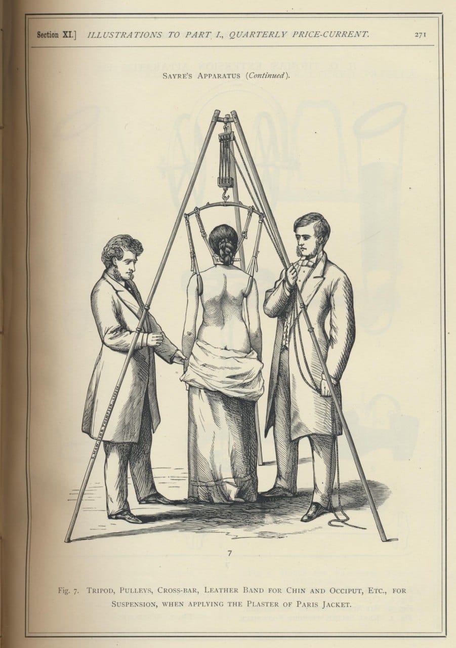 Lewis Sayre's 1882 apparatus for treating tuberculous spondylitis