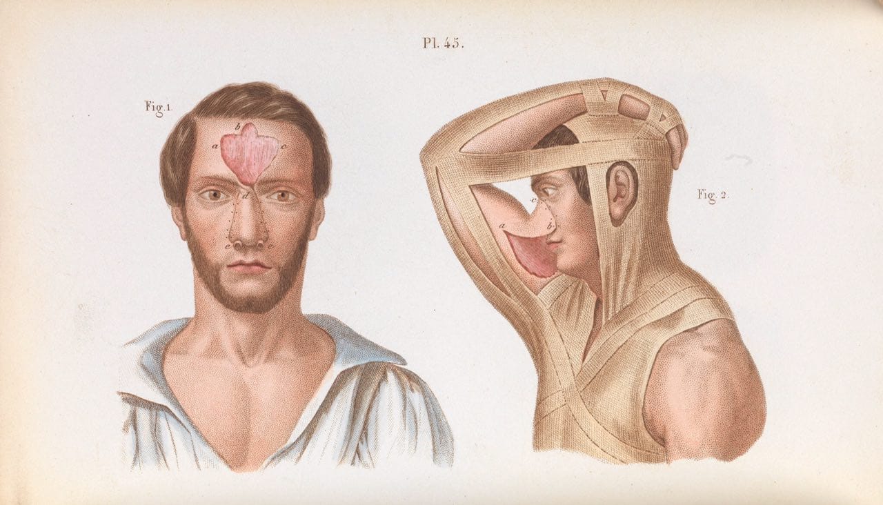 Colour plate of 1848: a man with a skin flap on his forehead and a man with his arm bandaged to his head.