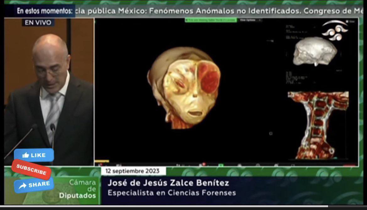 Capture de retransmission : un homme en costume devant un micro, à côté d'un écran montrant des scanners 3D d'un crâne allongé et de vertèbres. Légende : José de Jesús Zalce Benítez, expert 